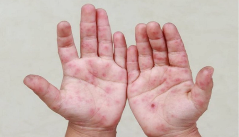 Junín emite alerta epidemiológica por aumento de casos de virus coxsackie en colegios y comunidades