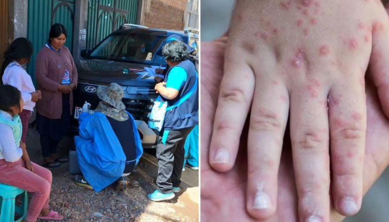 Casos de sarampión se elevan a ocho y confirman brote en Puno