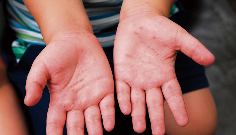 Lambayeque reporta 300 contagios por enfermedad viral que afecta niños