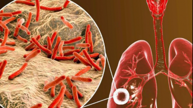 La tuberculosis se convierte en la enfermedad infecciosa más mortal, superando a la covid-19