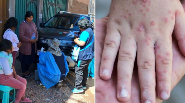 Casos de sarampión se elevan a ocho y confirman brote en Puno