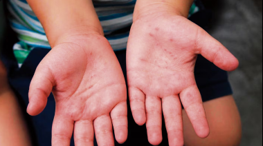 Lambayeque reporta 300 contagios por enfermedad viral que afecta niños