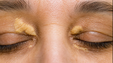 Esta señal amarilla alrededor de los ojos podría advertir problemas cardíacos y cerebrovasculares