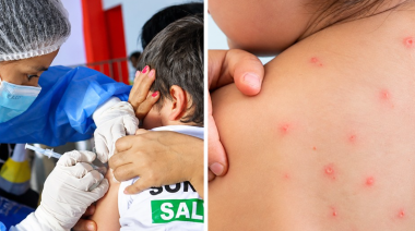 Casos de sarampión se duplican en Perú y podrían cuadruplicarse pronto