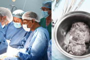 Niña de 4 años sobrevive a compleja cirugía por cáncer renal en Lima