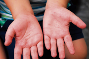 Lambayeque reporta 300 contagios por enfermedad viral que afecta niños