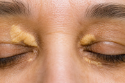 Esta señal amarilla alrededor de los ojos podría advertir problemas cardíacos y cerebrovasculares
