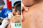 Casos de sarampión se duplican en Perú y podrían cuadruplicarse pronto